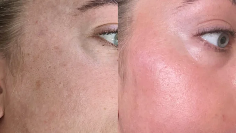 عکس قبل و بعد از لیزر co2 فرکشنال