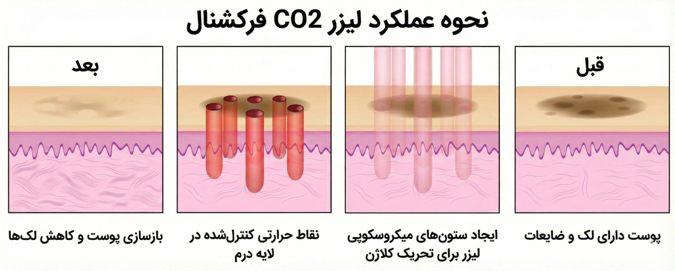 نحوه عملکرد لیزر co2 فرکشنال