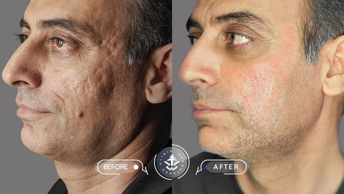 عکس قبل و بعد از لیزر اربیوم