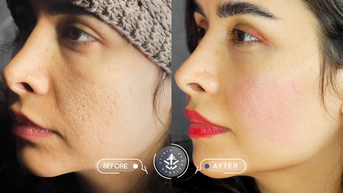 عکس قبل و بعد از لیزر اربیوم