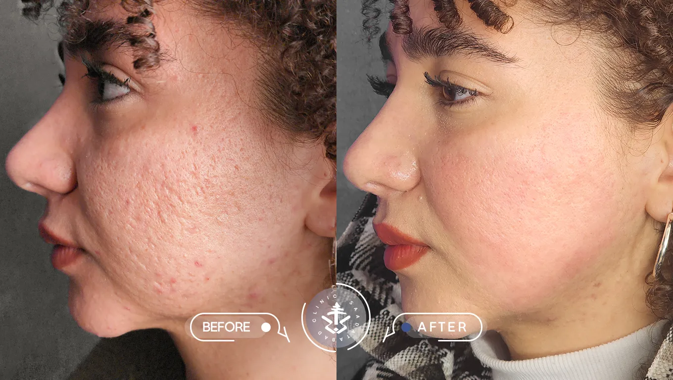 عکس قبل و بعد از لیزر اربیوم