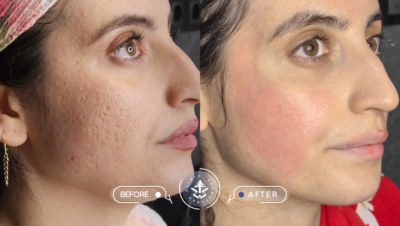 عکس قبل و بعد از لیزر اربیوم