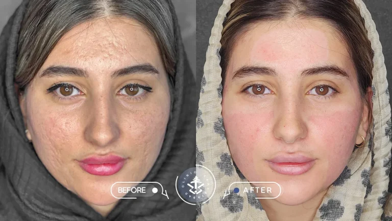 عکس قبل و بعد از لیزر اربیوم