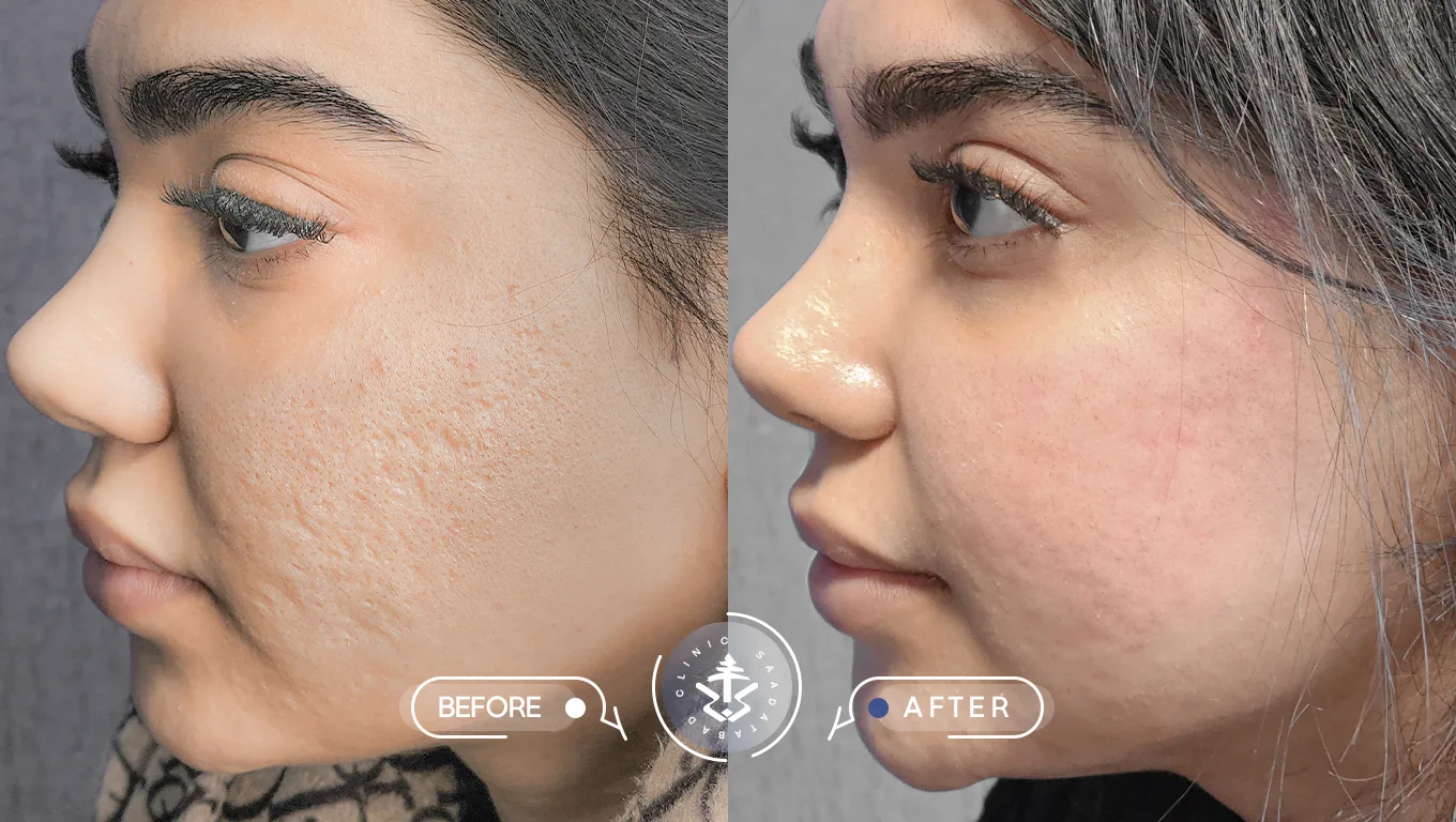 عکس قبل و بعد از لیزر اربیوم