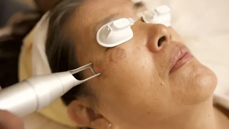 لیزر اربیوم