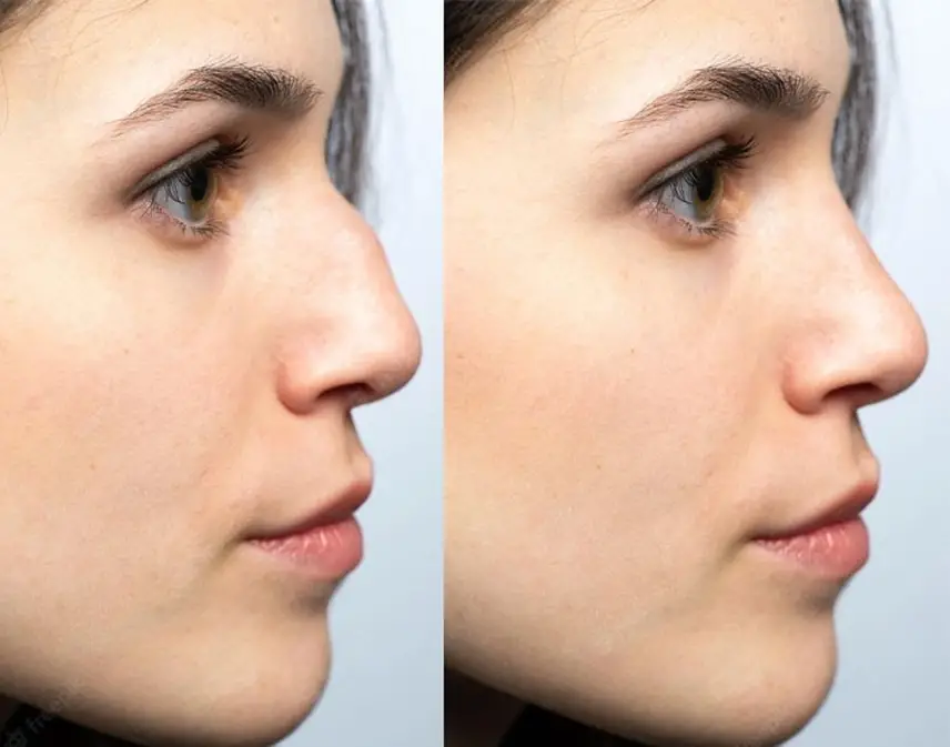 فیلر بینی چقدر میماند؟