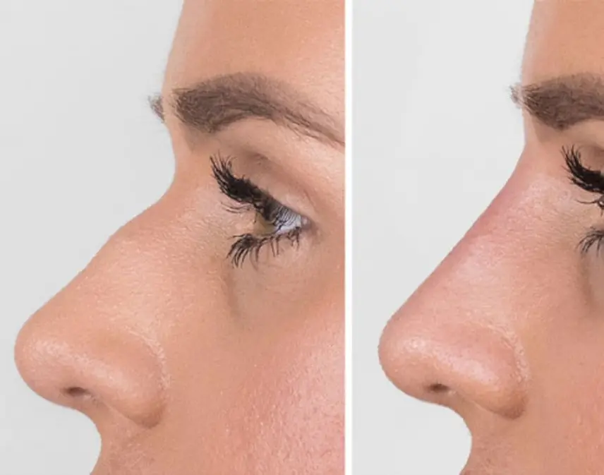 بهترین نتیجه از تزریق فیلر بینی