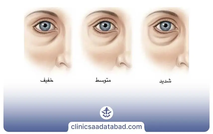 عوارض تزریق فیلر زیر چشم