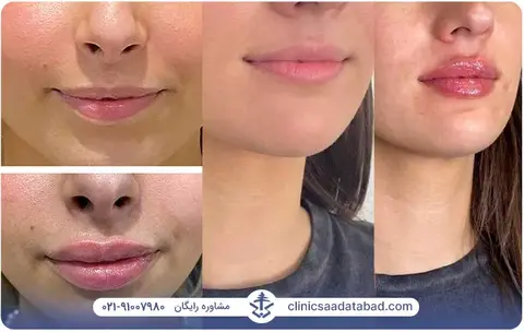 چگونه ورم بعد از تزریق ژل را از بین ببریم؟