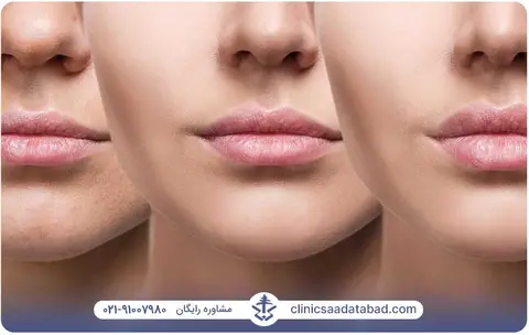 راههای جلوگیری از تورم صورت بعد از تزریق ژل