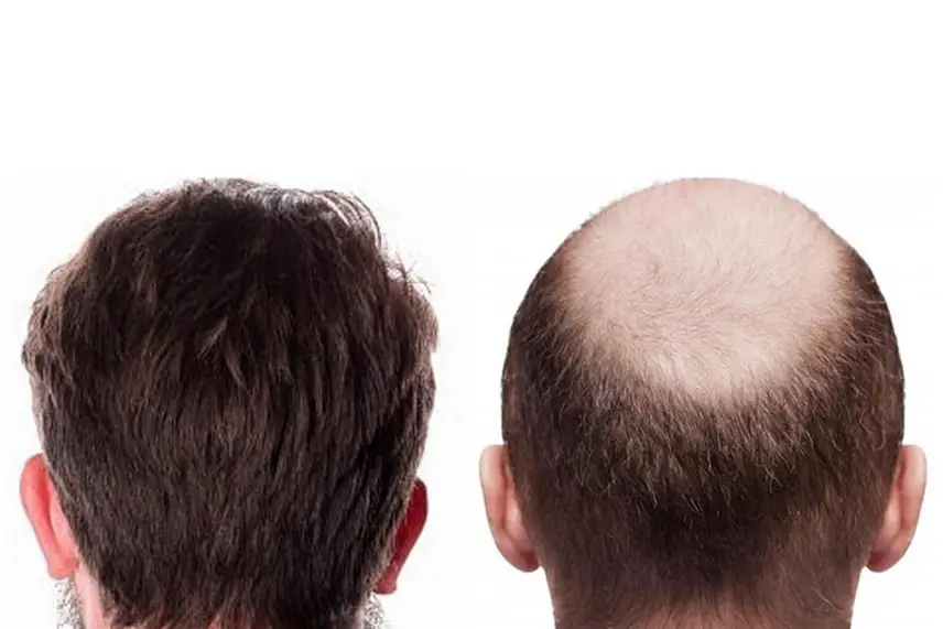 بهترین سن برای کاشت مو