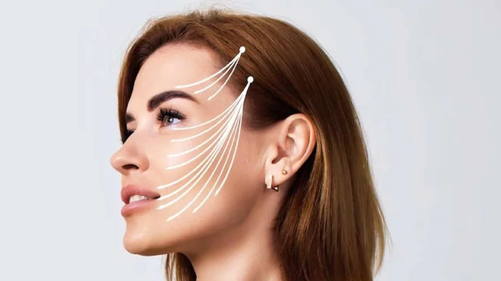 لیفت صورت با نخ