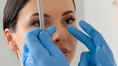 رینوپلاستی