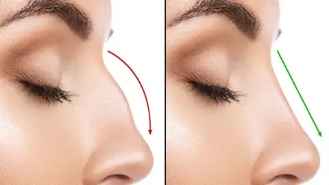 روند بهبودی پس از جراحی زیبایی بینی