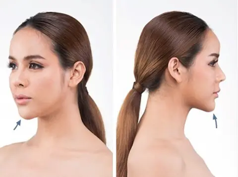 فرایند جراحی زیبایی فک