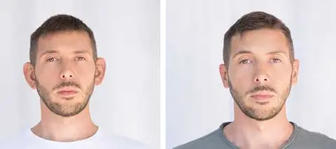 چه کسانی برای جراحی زیبایی گوش مناسب هستند؟