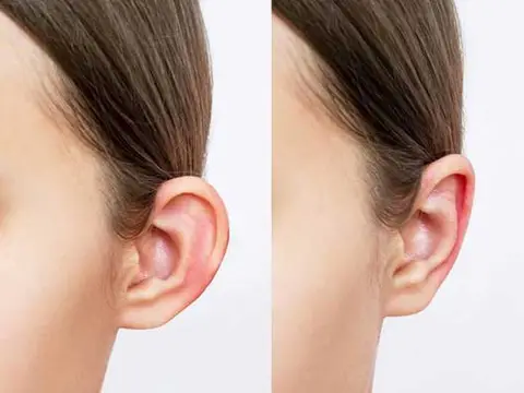 حراحی اتوپلاستی