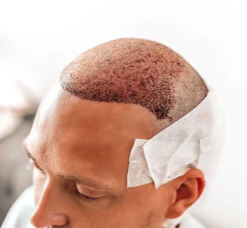 انواع مختلف کاشت مو