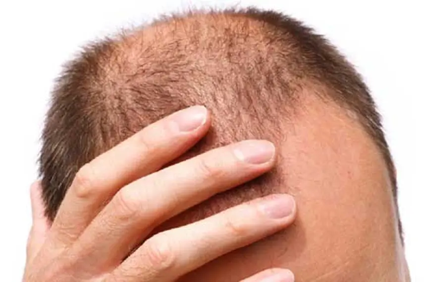 میزان موفقیت کاشت مو چقدر است؟