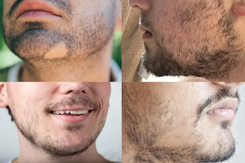 جراحی کاشت ریش