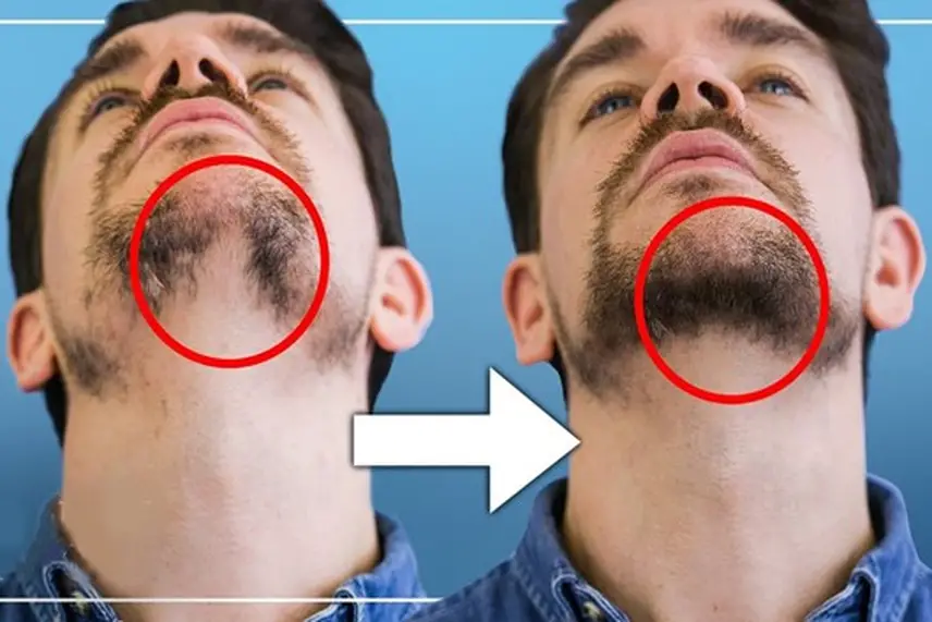 انواع روش های کاشت ریش