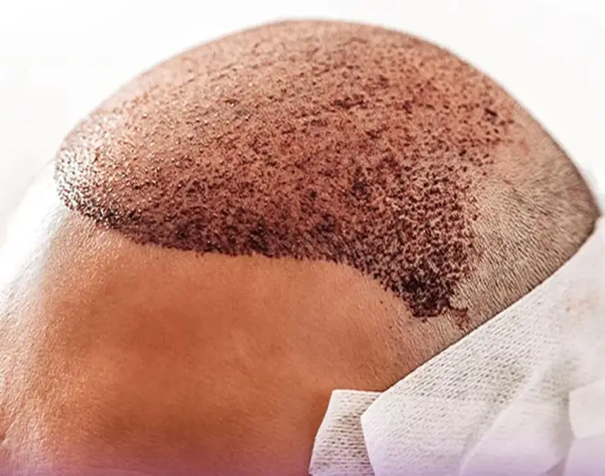 خارش بعد از کاشت مو