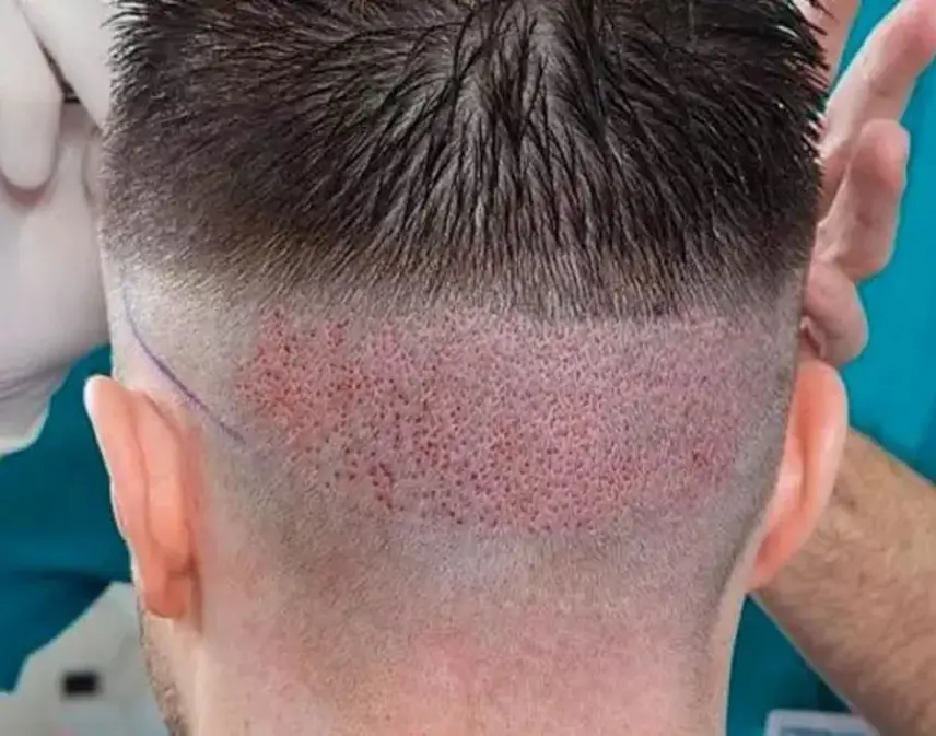  درمان خارش بعد از کاشت مو