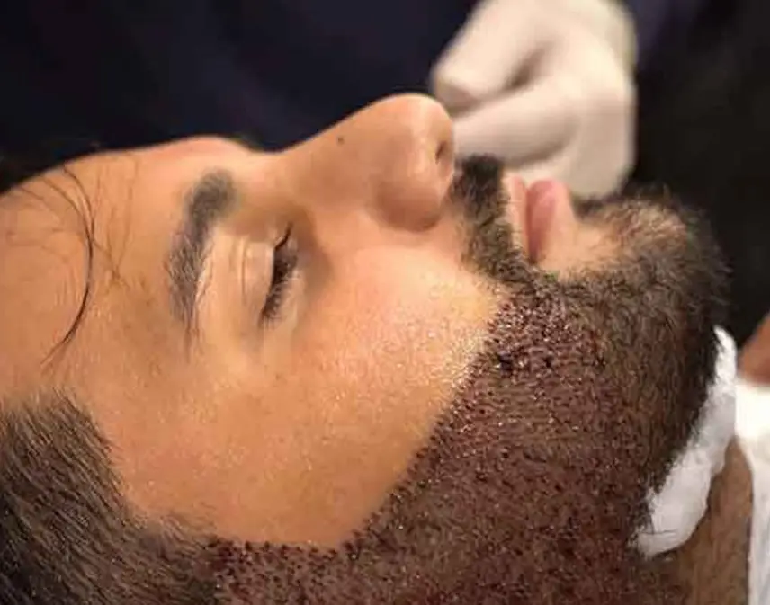 مدت زمان دوره نقاهت بعد از کاشت ریش