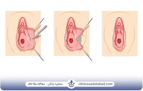 مراقبت های بعد از لابیاپلاستی