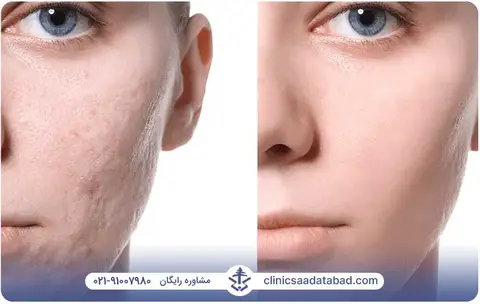 لیزر درمانی لک پوست