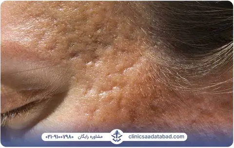 روش‌های درمان لک‌های صورت و حذف خال بدون جراحی