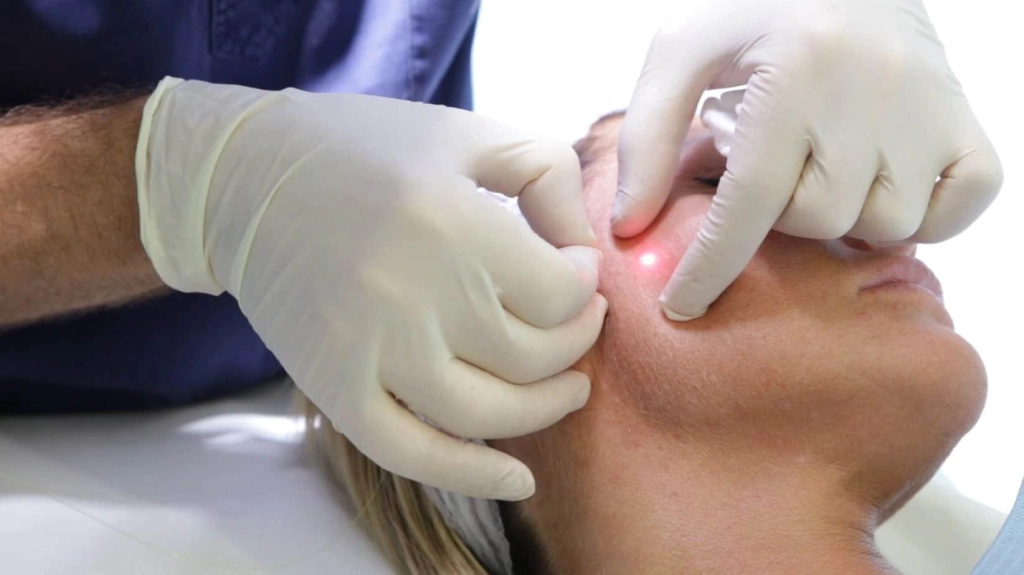 نحوه انجام اندولیفت 