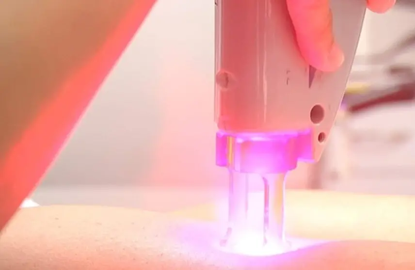 لیزر موهای زائد چیست؟