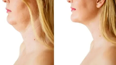 لیفت صورت و گردن برای چه کسانی مناسب است؟