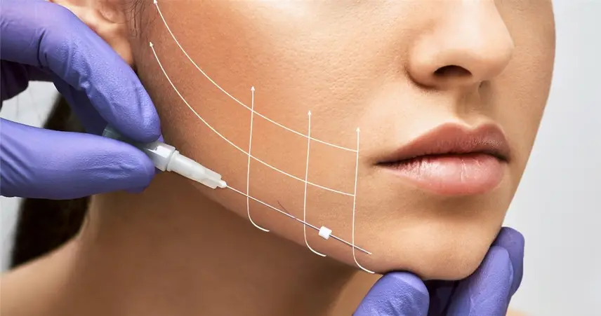فرایند روش لیفت صورت با نخ