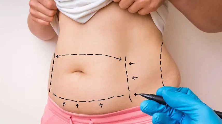 نکات مهم قبل از عمل لیپوماتیک