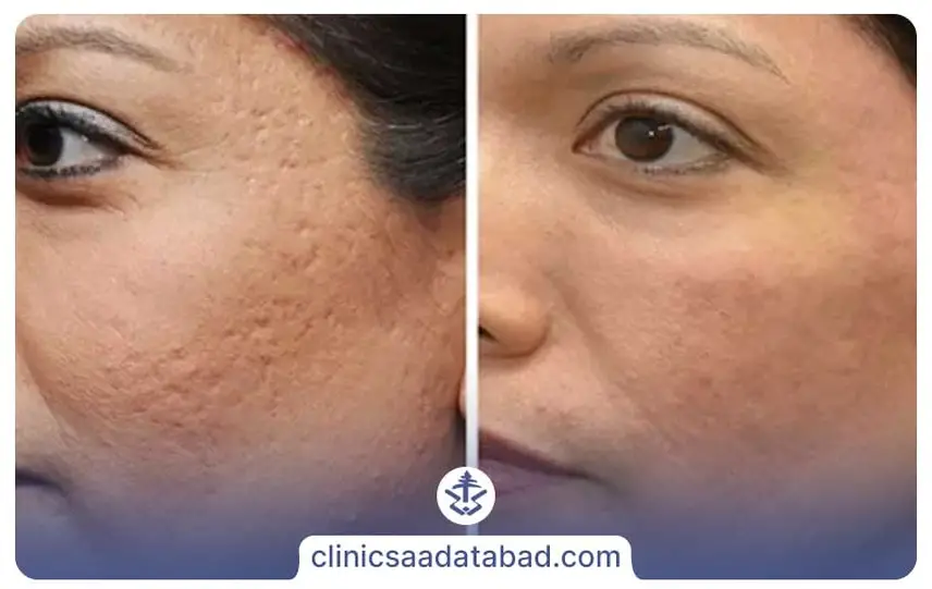 مراقبت‏ های بعد از مزوتراپی پوست