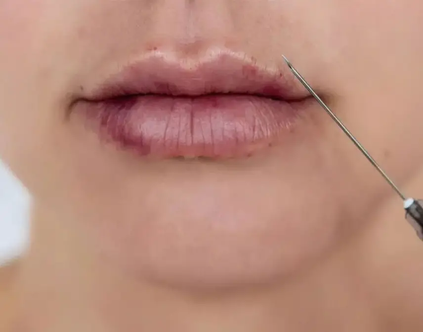 نکروز بعد از تزریق چربی به لب