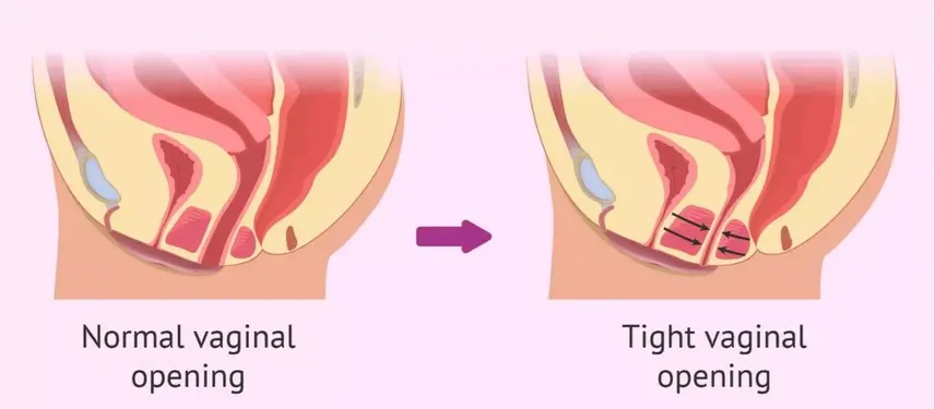 تجربه عارضه واژینیسموس