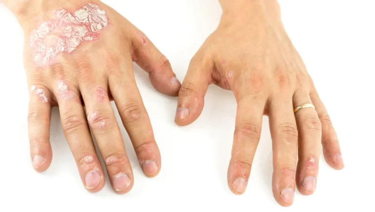 قاتل پسوریازیس