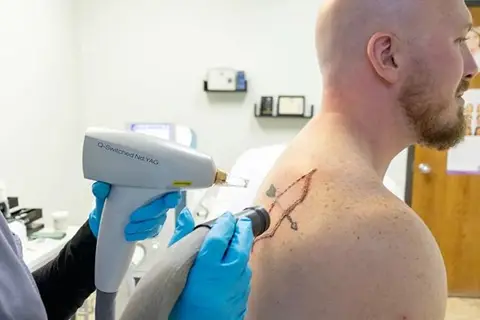 حذف تتو با لیزر