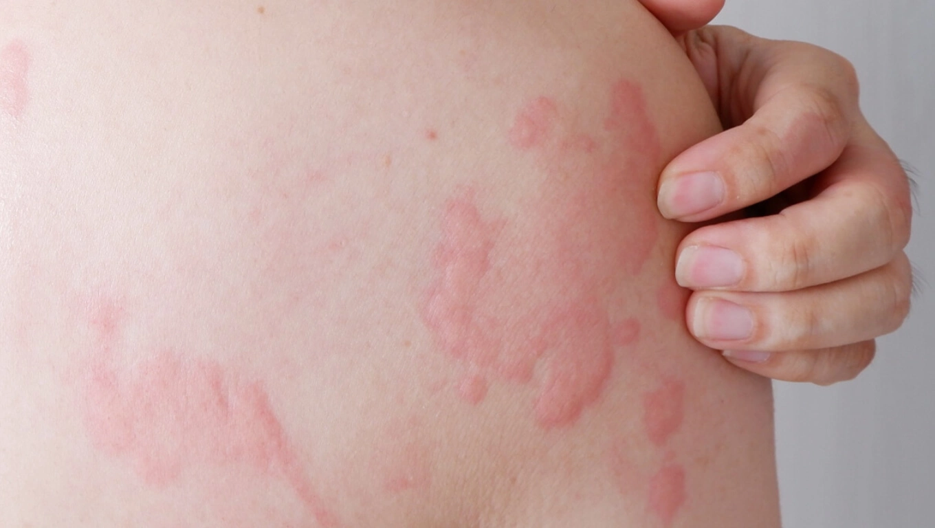 لکه های قرمز کهیر 