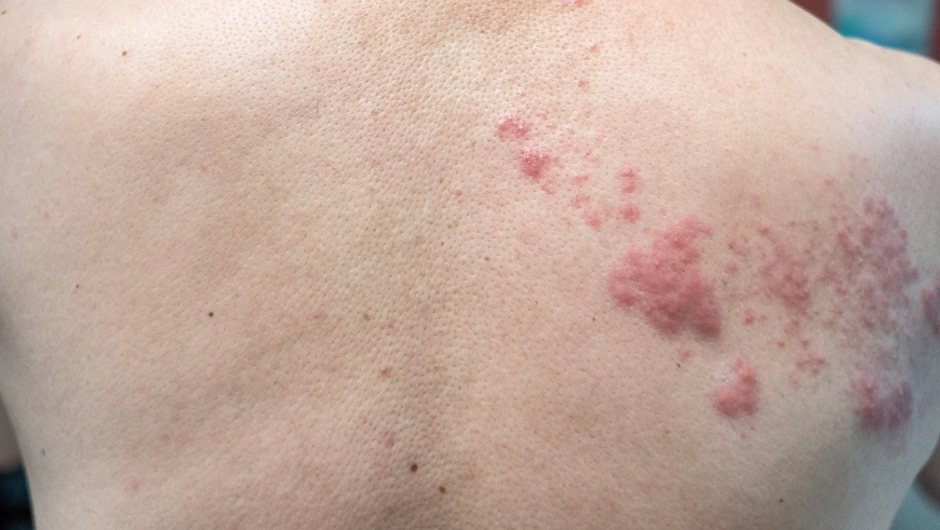 لکه های قرمز پوستی زونا