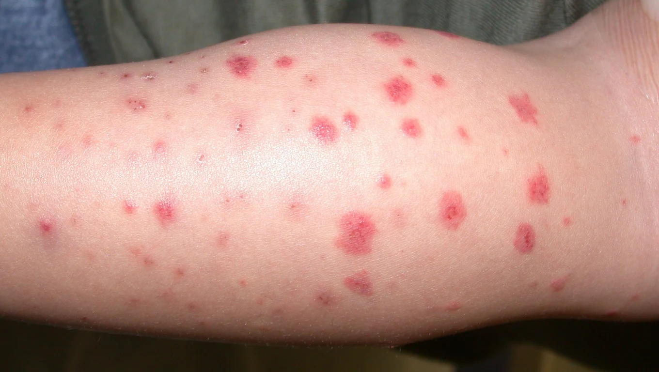 لکه های قرمز پوستی پتشیا و پورپورا