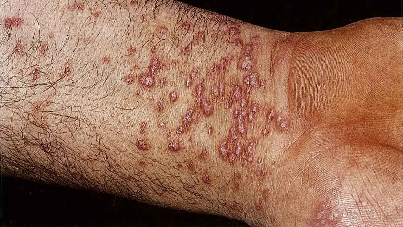 لکه های قرمز پوستی لیکن پلان 