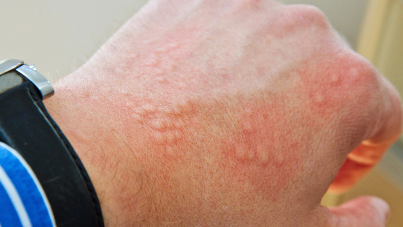 لکه های قرمز درماتیت تماسی