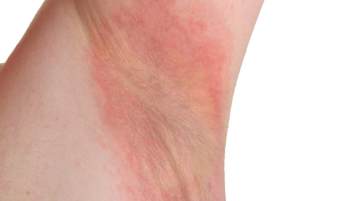 لکه های قرمز پوستی عرق سوز