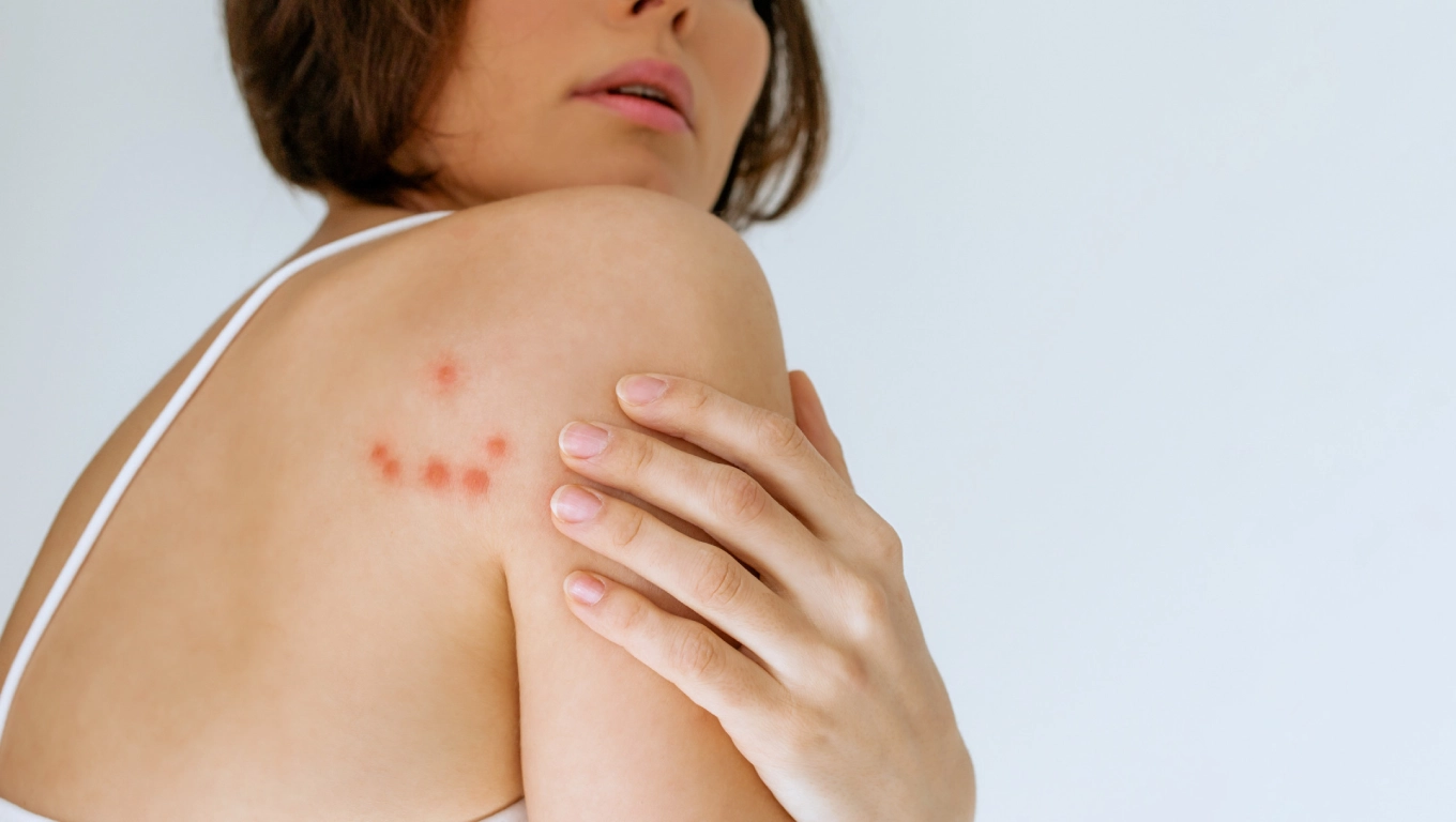 لکه های قرمز پوستی نیش حشرات