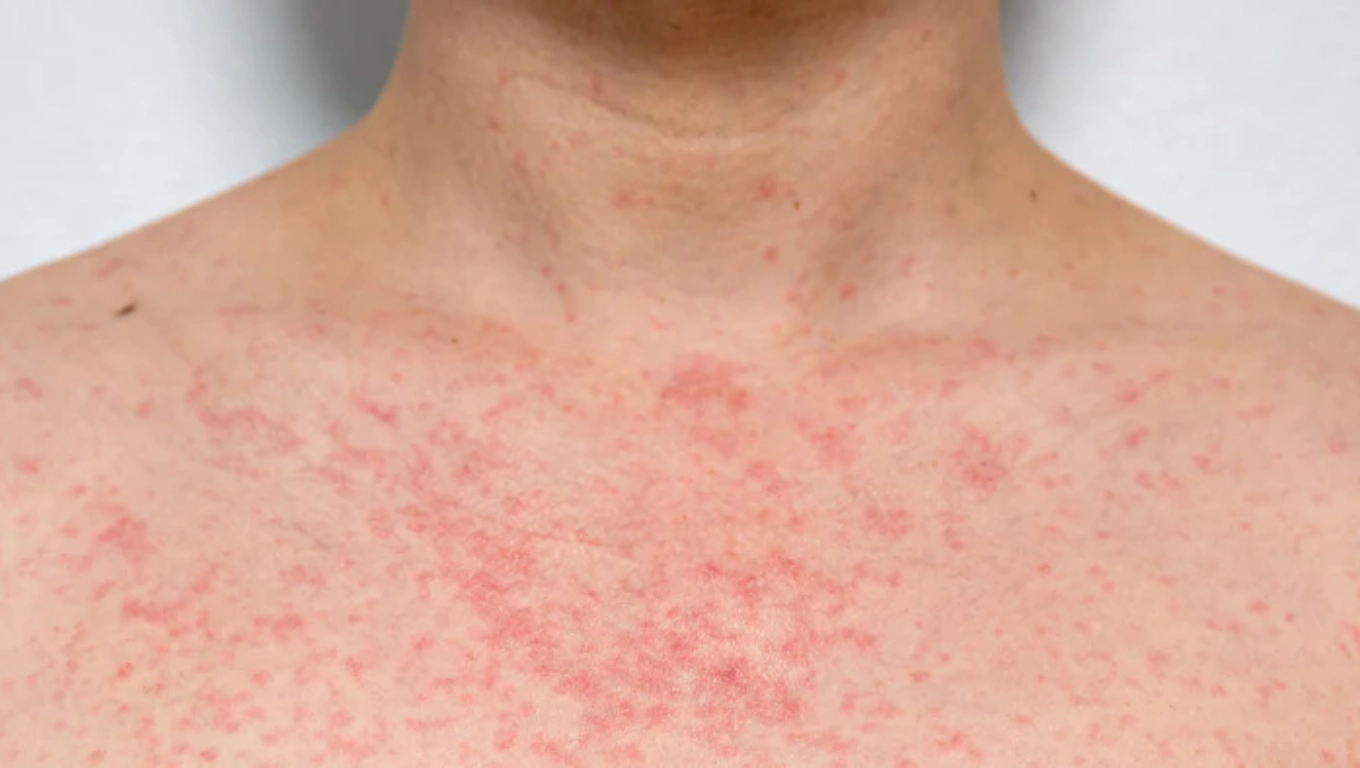 لکه های قرمز راش گرمایی