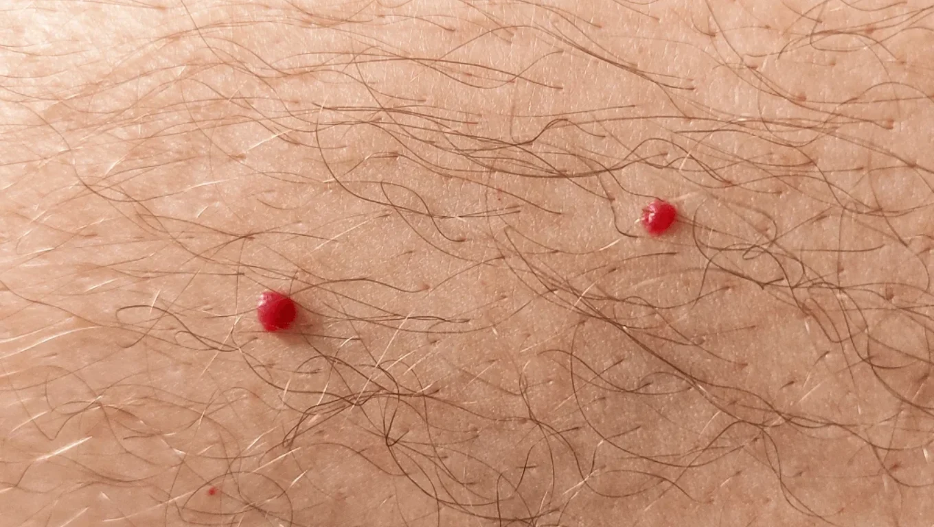 لکه های قرمز پوستی آنژیوم گیلاسی